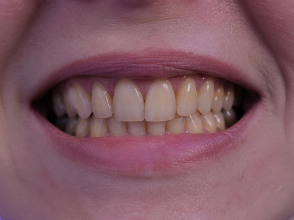 Dull, yellowed and coffee-stained teeth before using WHITR